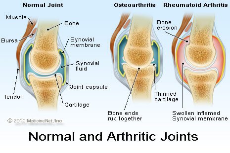 Can Image Analysis Help in the Fight Against Osteoarthritis 3