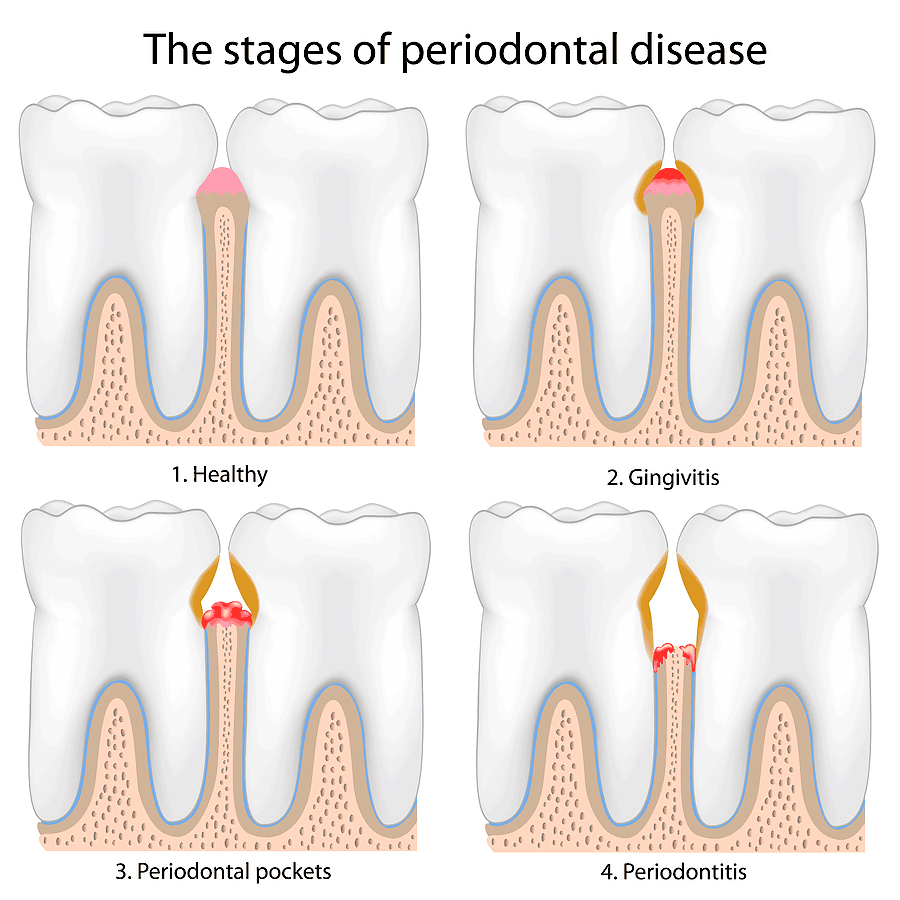 periodontal-disease